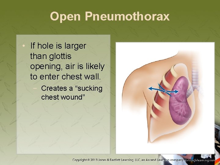 Open Pneumothorax • If hole is larger than glottis opening, air is likely to