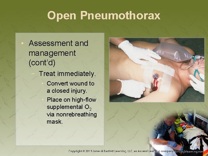 Open Pneumothorax • Assessment and management (cont’d) − Treat immediately. • Convert wound to
