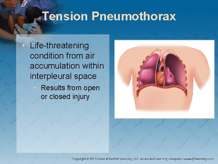 Tension Pneumothorax • Life-threatening condition from air accumulation within interpleural space − Results from