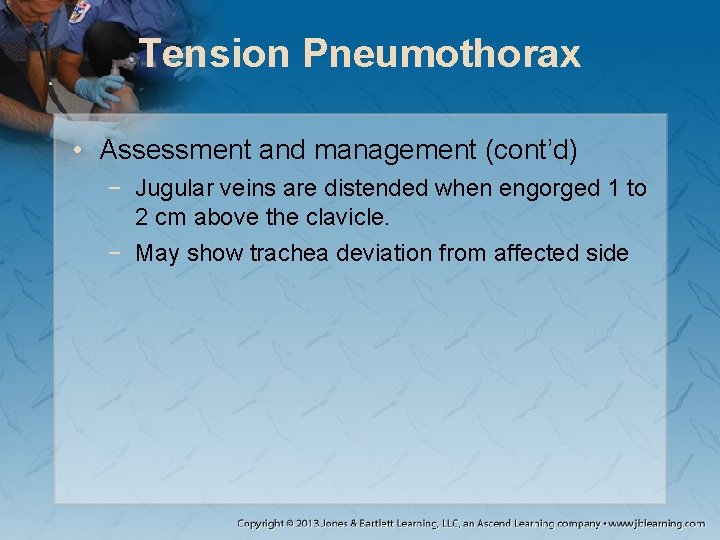 Tension Pneumothorax • Assessment and management (cont’d) − Jugular veins are distended when engorged