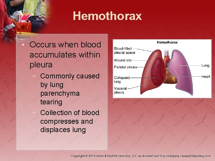 Hemothorax • Occurs when blood accumulates within pleura − Commonly caused by lung parenchyma