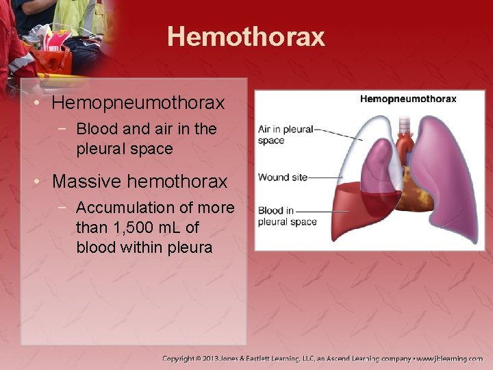 Hemothorax • Hemopneumothorax − Blood and air in the pleural space • Massive hemothorax