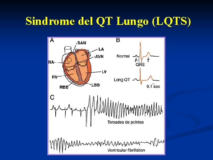 Sindrome del QT Lungo (LQTS) 