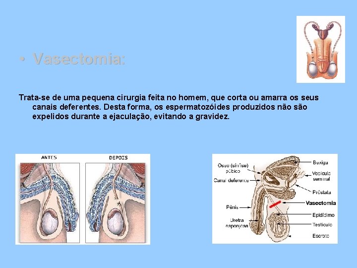  • Vasectomia: Trata-se de uma pequena cirurgia feita no homem, que corta ou