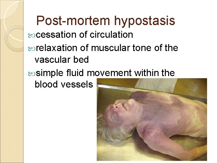 Post-mortem hypostasis cessation of circulation relaxation of muscular tone of the vascular bed simple