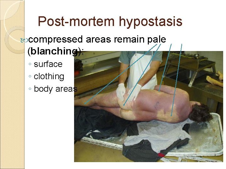 Post-mortem hypostasis compressed (blanching): ◦ surface ◦ clothing ◦ body areas remain pale 