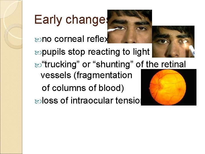 Early changes no corneal reflex pupils stop reacting to light “trucking” or “shunting” of