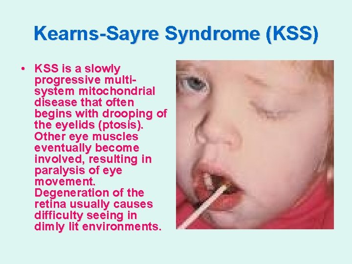 Kearns-Sayre Syndrome (KSS) • KSS is a slowly progressive multisystem mitochondrial disease that often