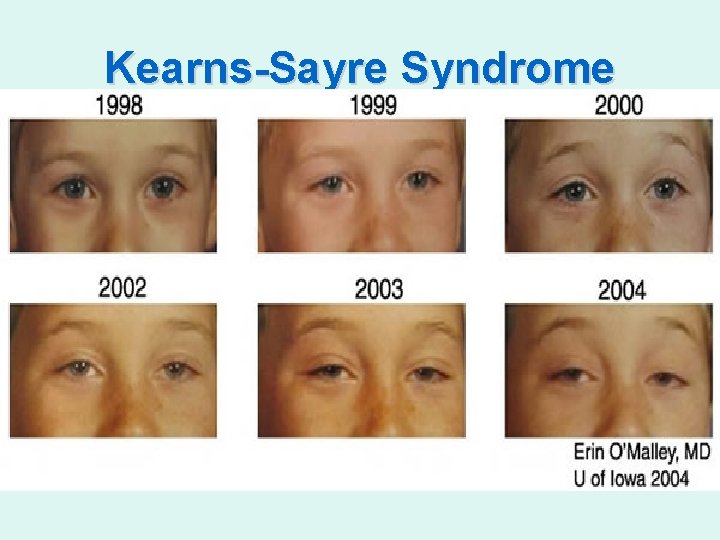 Kearns-Sayre Syndrome 