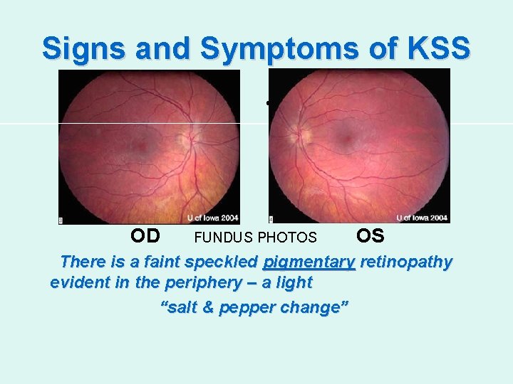Signs and Symptoms of KSS OD OD • OS FUNDUS PHOTOS OS There is