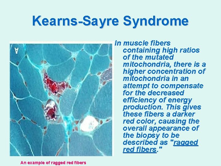 Kearns-Sayre Syndrome In muscle fibers containing high ratios of the mutated mitochondria, there is