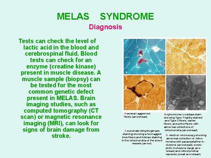 MELAS SYNDROME Diagnosis Tests can check the level of lactic acid in the blood