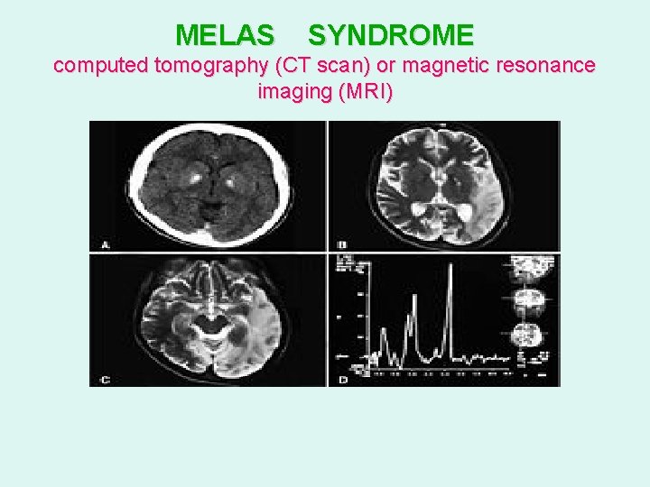 MELAS SYNDROME computed tomography (CT scan) or magnetic resonance imaging (MRI) 