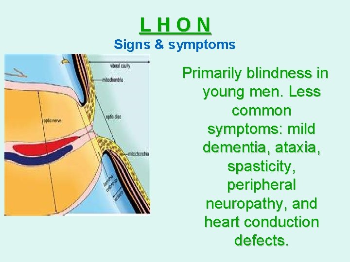 LHON Signs & symptoms Primarily blindness in young men. Less common symptoms: mild dementia,