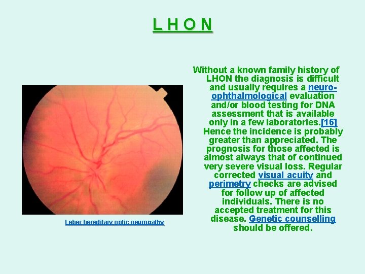 LHON Leber hereditary optic neuropathy Without a known family history of LHON the diagnosis