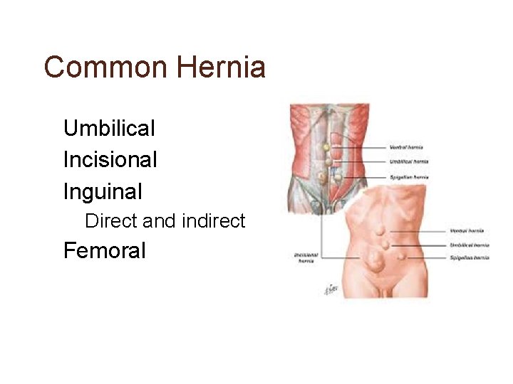 Common Hernia • Umbilical • Incisional • Inguinal – Direct and indirect • Femoral