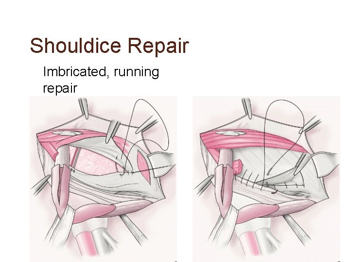 Shouldice Repair • Imbricated, running repair 