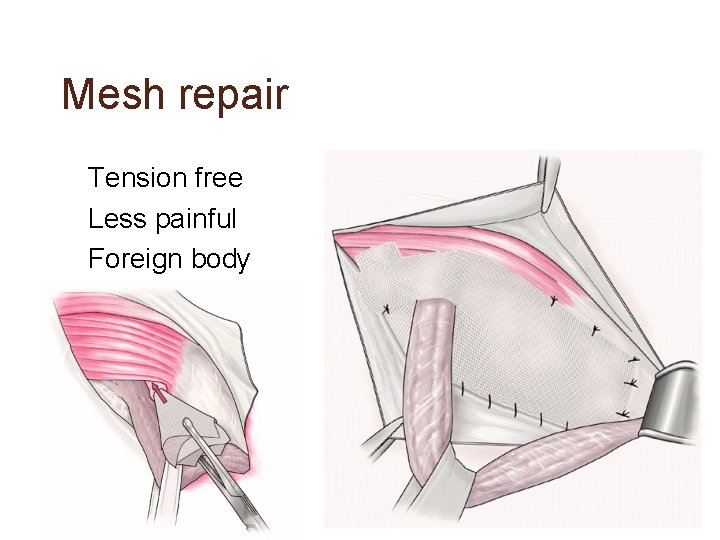 Mesh repair • Tension free • Less painful • Foreign body 