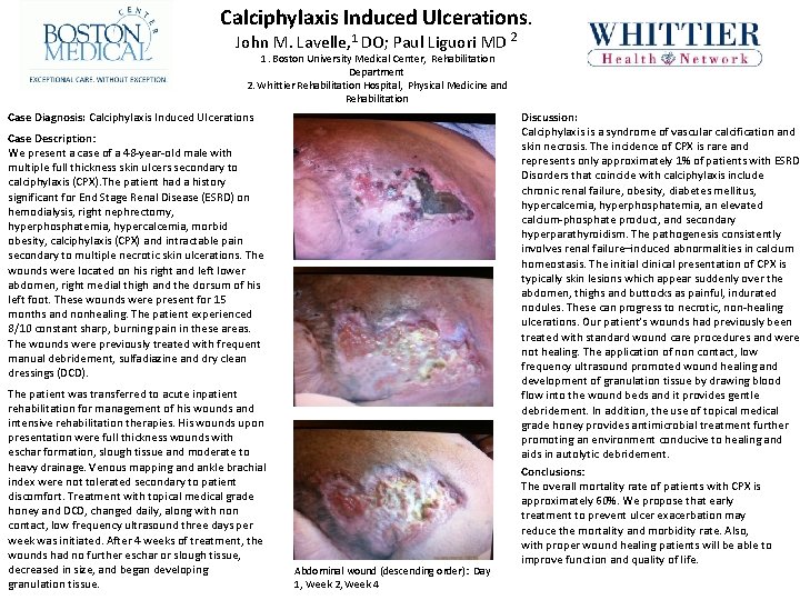 Calciphylaxis Induced Ulcerations. John M. Lavelle, 1 DO; Paul Liguori MD 2 1. Boston