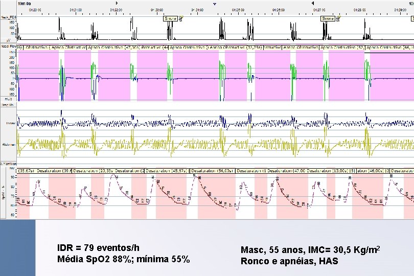 IDR = 79 eventos/h Média Sp. O 2 88%; mínima 55% Masc, 55 anos,
