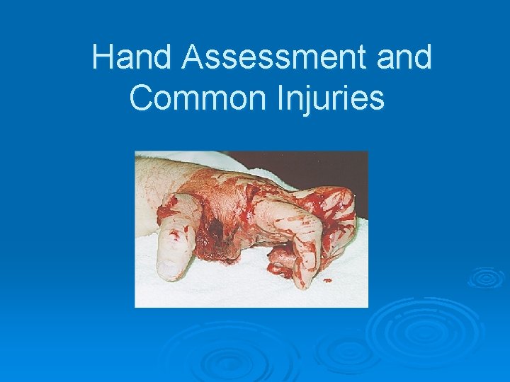 Hand Assessment and Common Injuries 