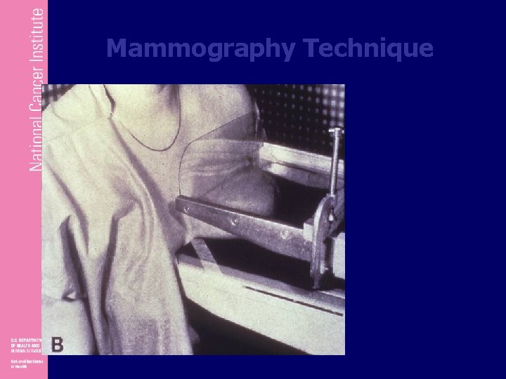 Mammography Technique 