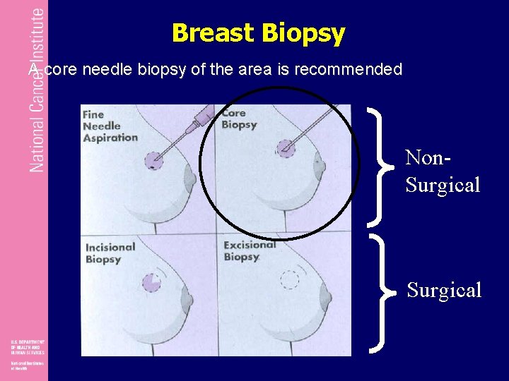 Breast Biopsy A core needle biopsy of the area is recommended Non. Surgical 