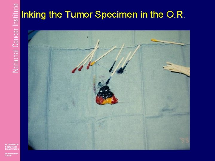 Inking the Tumor Specimen in the O. R. 