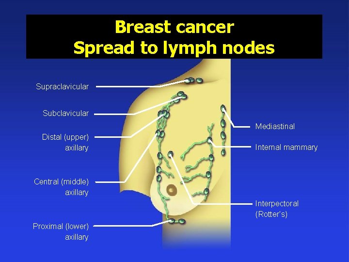 Breast cancer Spread to lymph nodes Supraclavicular Subclavicular Mediastinal Distal (upper) axillary Internal mammary