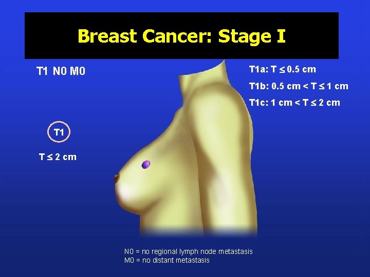 Breast Cancer: Stage I T 1 N 0 M 0 T 1 a: T