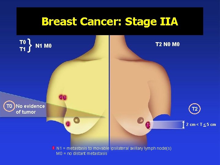 Breast Cancer: Stage IIA T 0 T 1 } N 1 M 0 T