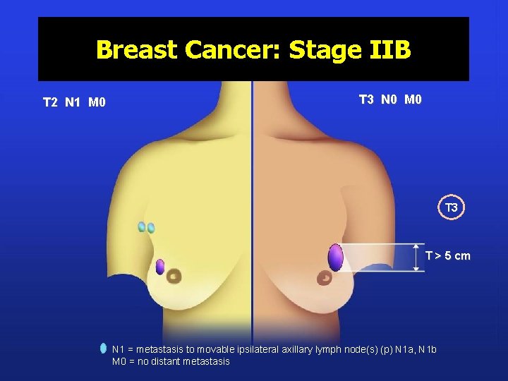 Breast Cancer: Stage IIB T 2 N 1 M 0 T 3 N 0