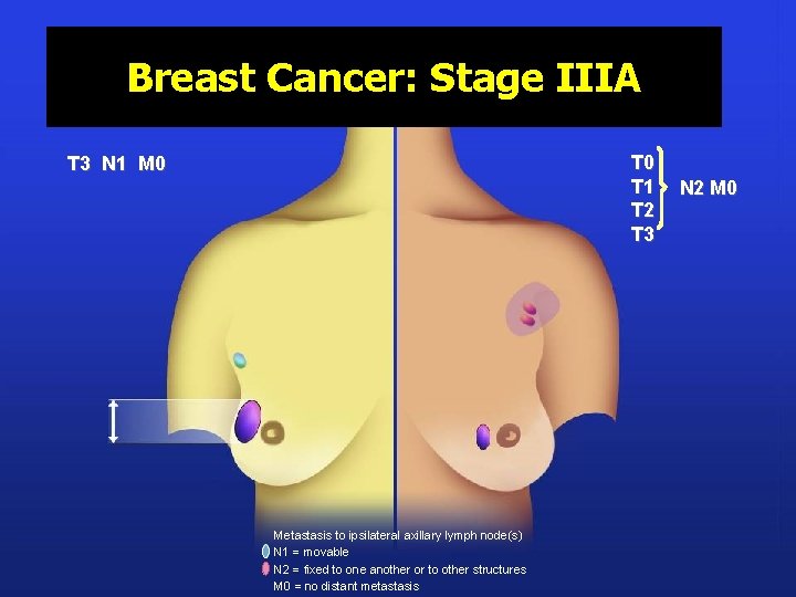 Breast Cancer: Stage IIIA T 0 T 1 T 2 T 3 N 1