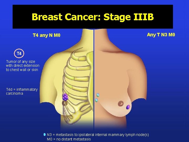 Breast Cancer: Stage IIIB T 4 any N M 0 Any T N 3