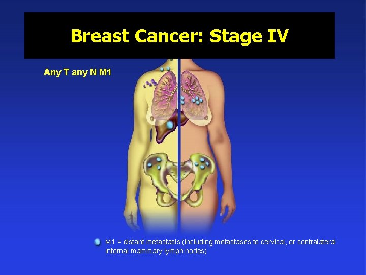 Breast Cancer: Stage IV Any T any N M 1 = distant metastasis (including