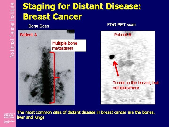 Staging for Distant Disease: Breast Cancer FDG PET scan Bone Scan Patient A Patient