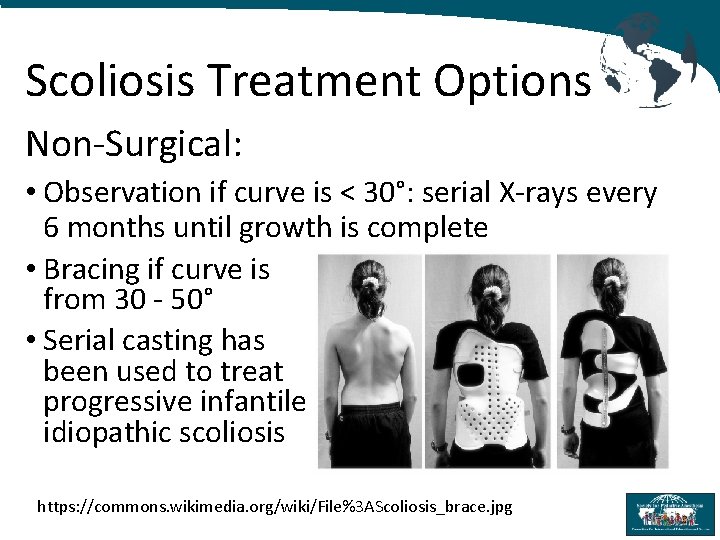 Scoliosis Treatment Options Non-Surgical: • Observation if curve is < 30°: serial X-rays every