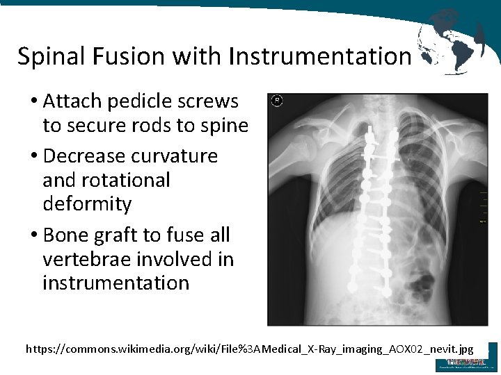 Spinal Fusion with Instrumentation • Attach pedicle screws to secure rods to spine •