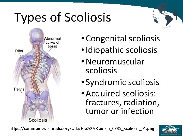 Types of Scoliosis • Congenital scoliosis • Idiopathic scoliosis • Neuromuscular scoliosis • Syndromic