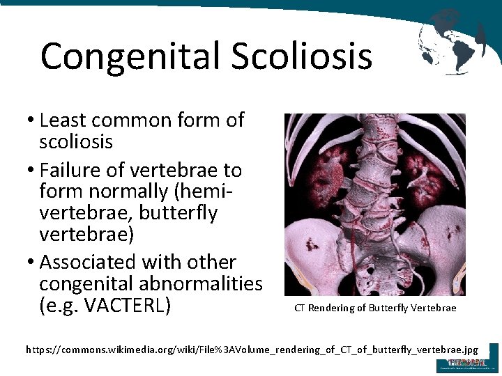 Congenital Scoliosis • Least common form of scoliosis • Failure of vertebrae to form
