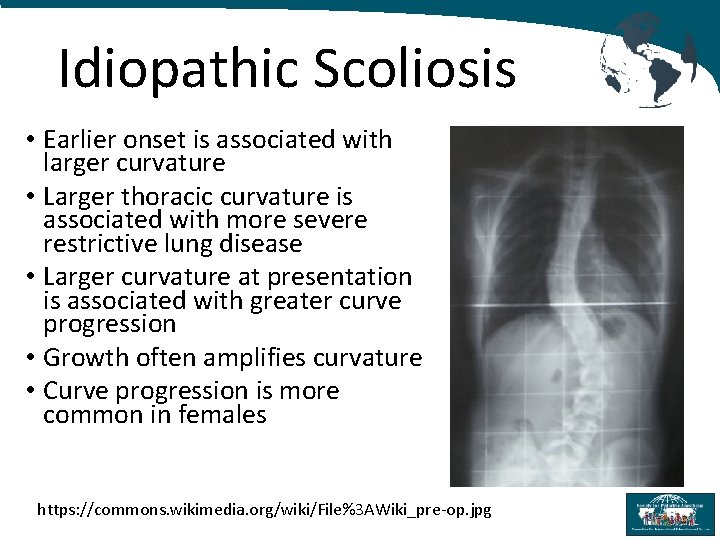 Idiopathic Scoliosis • Earlier onset is associated with larger curvature • Larger thoracic curvature