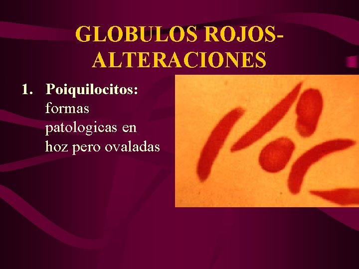 GLOBULOS ROJOSALTERACIONES 1. Poiquilocitos: formas patologicas en hoz pero ovaladas 