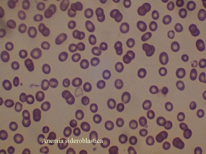 Anemia sideroblastica 