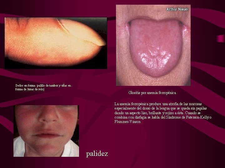 Dedos en forma palillo de tambor y uñas en forma de lunas de reloj