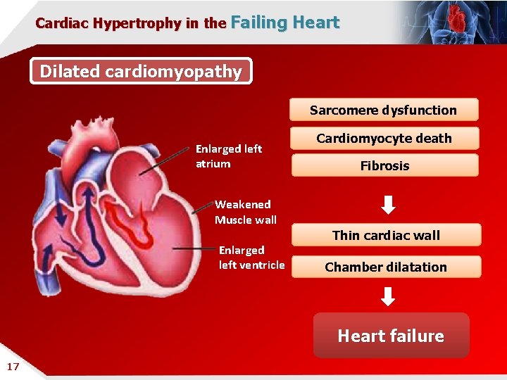 Cardiac Hypertrophy in the Failing Heart Dilated cardiomyopathy Sarcomere dysfunction Enlarged left atrium Cardiomyocyte