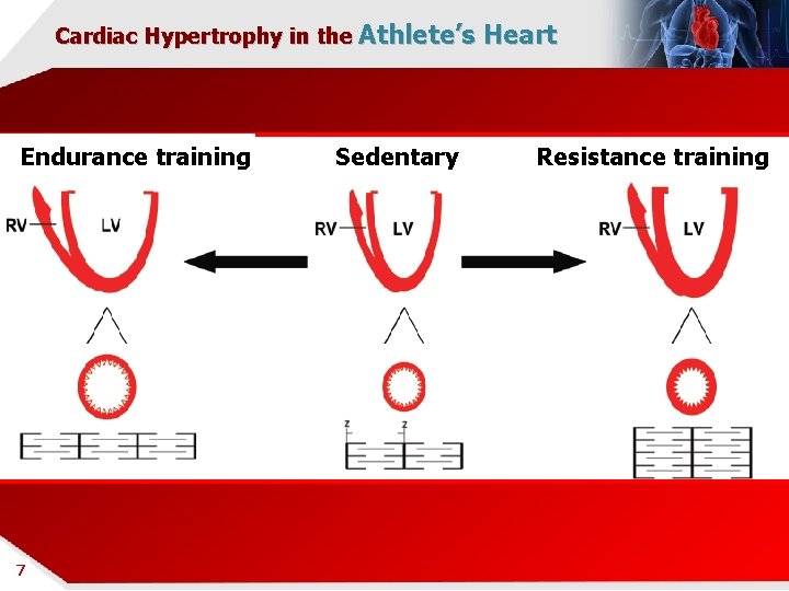 Cardiac Hypertrophy in the Athlete’s Heart ENDURANCE TRAINING Endurance training 7 7 Sedentary Resistance