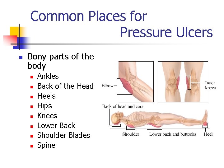 Common Places for Pressure Ulcers n Bony parts of the body n n n