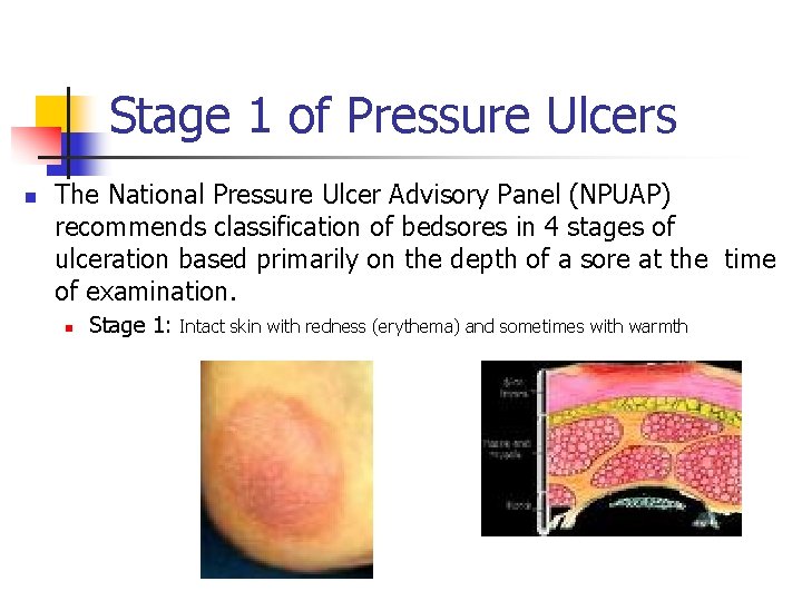 Stage 1 of Pressure Ulcers n The National Pressure Ulcer Advisory Panel (NPUAP) recommends