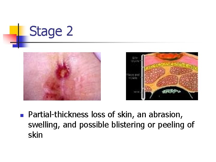 Stage 2 n Partial-thickness loss of skin, an abrasion, swelling, and possible blistering or