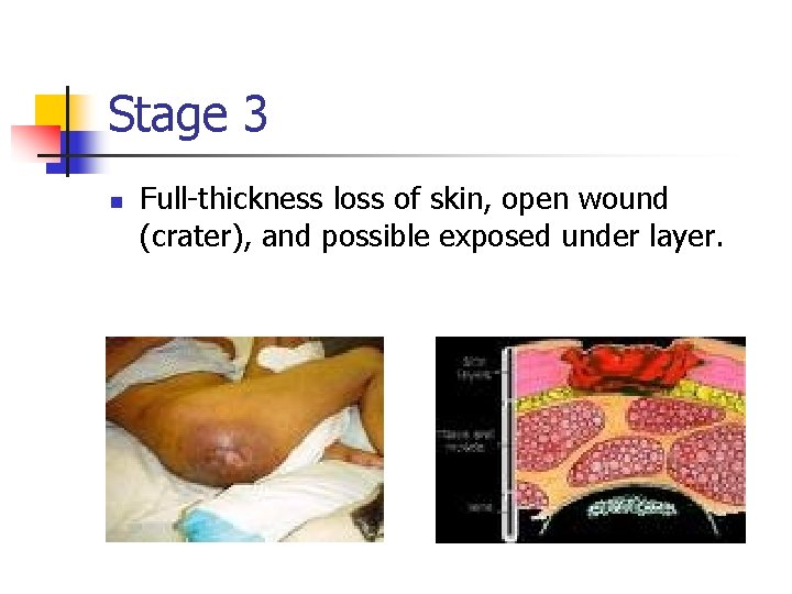 Stage 3 n Full-thickness loss of skin, open wound (crater), and possible exposed under